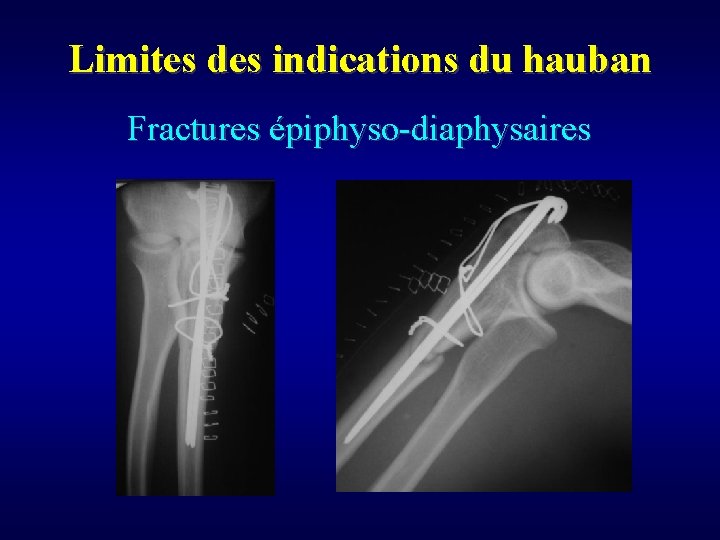 Limites des indications du hauban Fractures épiphyso-diaphysaires 