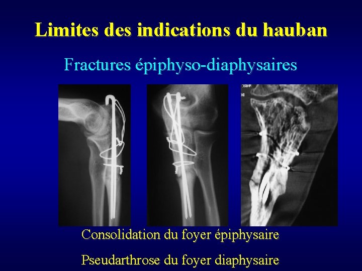 Limites des indications du hauban Fractures épiphyso-diaphysaires Consolidation du foyer épiphysaire Pseudarthrose du foyer