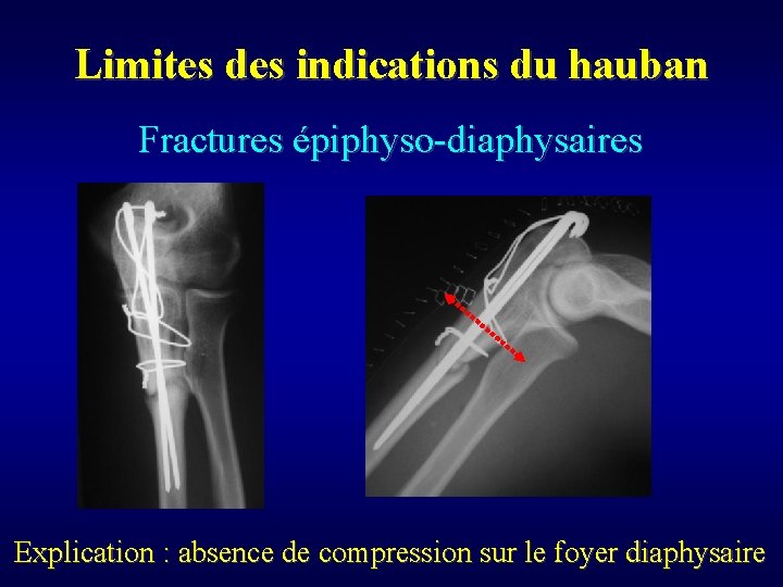 Limites des indications du hauban Fractures épiphyso-diaphysaires Explication : absence de compression sur le
