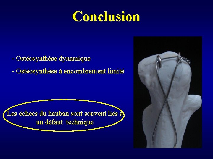 Conclusion - Ostéosynthèse dynamique - Ostéosynthèse à encombrement limité Les échecs du hauban sont