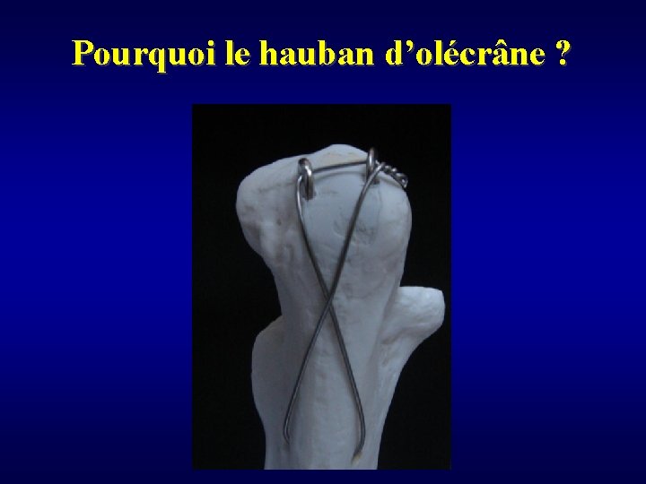 Pourquoi le hauban d’olécrâne ? 