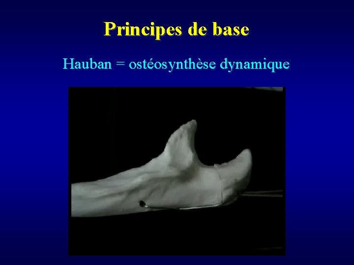 Principes de base Hauban = ostéosynthèse dynamique 