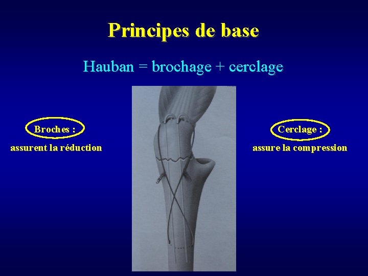 Principes de base Hauban = brochage + cerclage Broches : Cerclage : assurent la