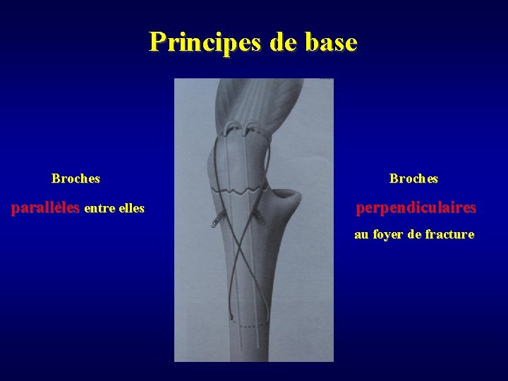 Principes de base Broches parallèles entre elles perpendiculaires au foyer de fracture 