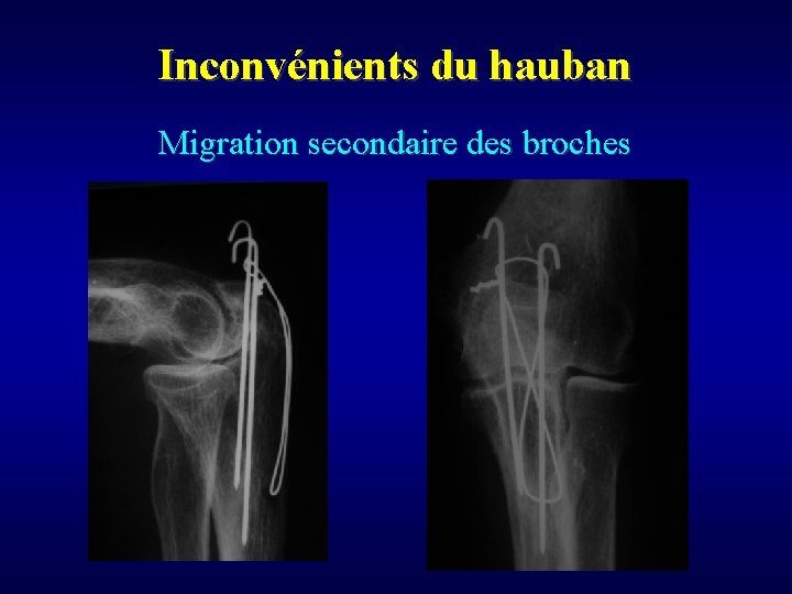 Inconvénients du hauban Migration secondaire des broches 