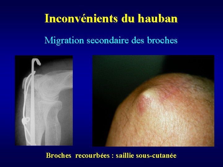 Inconvénients du hauban Migration secondaire des broches Broches recourbées : saillie sous-cutanée 
