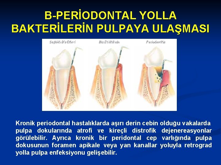 B-PERİODONTAL YOLLA BAKTERİLERİN PULPAYA ULAŞMASI Kronik periodontal hastalıklarda aşırı derin cebin olduğu vakalarda pulpa