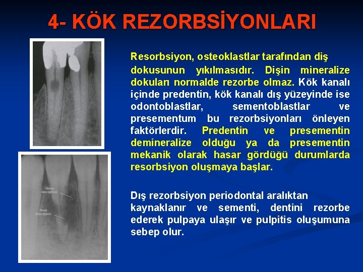 4 - KÖK REZORBSİYONLARI Resorbsiyon, osteoklastlar tarafından diş dokusunun yıkılmasıdır. Dişin mineralize dokuları normalde