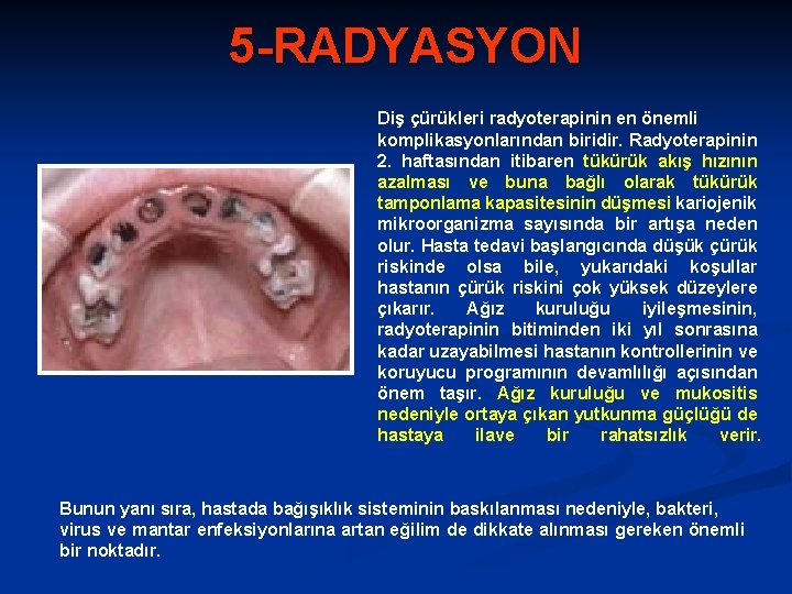 5 -RADYASYON Diş çürükleri radyoterapinin en önemli komplikasyonlarından biridir. Radyoterapinin 2. haftasından itibaren tükürük