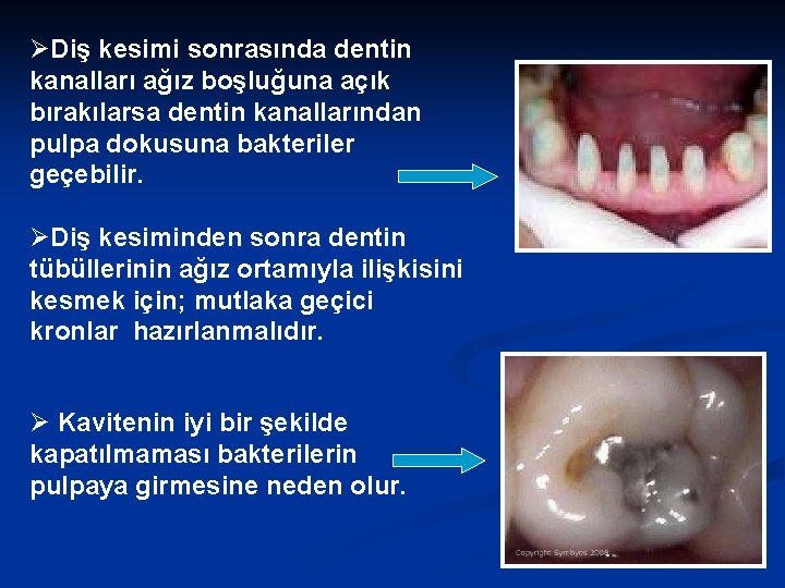 ØDiş kesimi sonrasında dentin kanalları ağız boşluğuna açık bırakılarsa dentin kanallarından pulpa dokusuna bakteriler