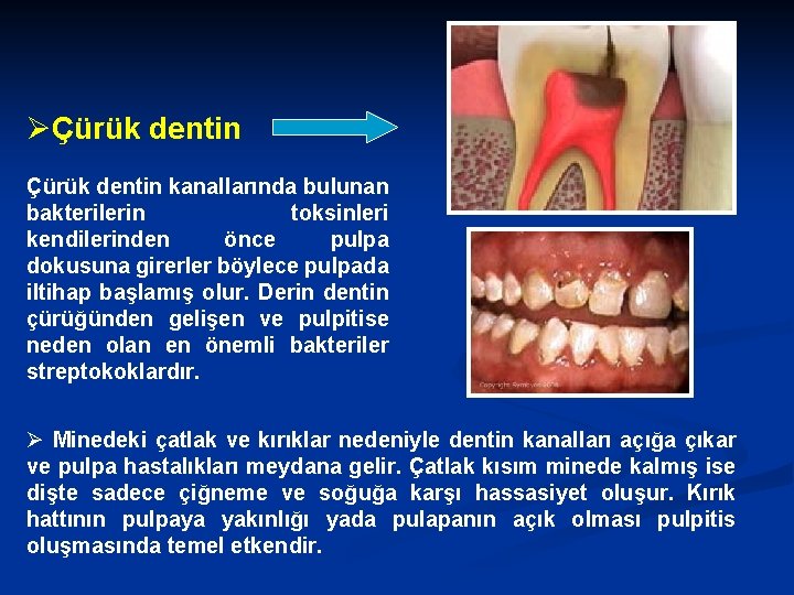 ØÇürük dentin kanallarında bulunan bakterilerin toksinleri kendilerinden önce pulpa dokusuna girerler böylece pulpada iltihap
