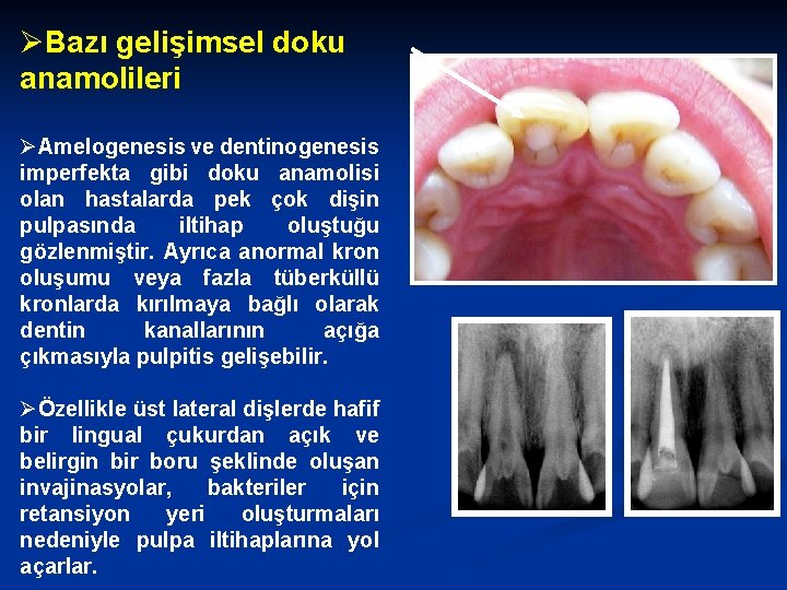 ØBazı gelişimsel doku anamolileri ØAmelogenesis ve dentinogenesis imperfekta gibi doku anamolisi olan hastalarda pek