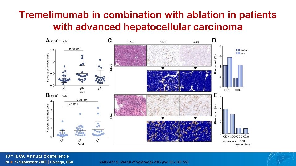 Tremelimumab in combination with ablation in patients with advanced hepatocellular carcinoma 13 th ILCA