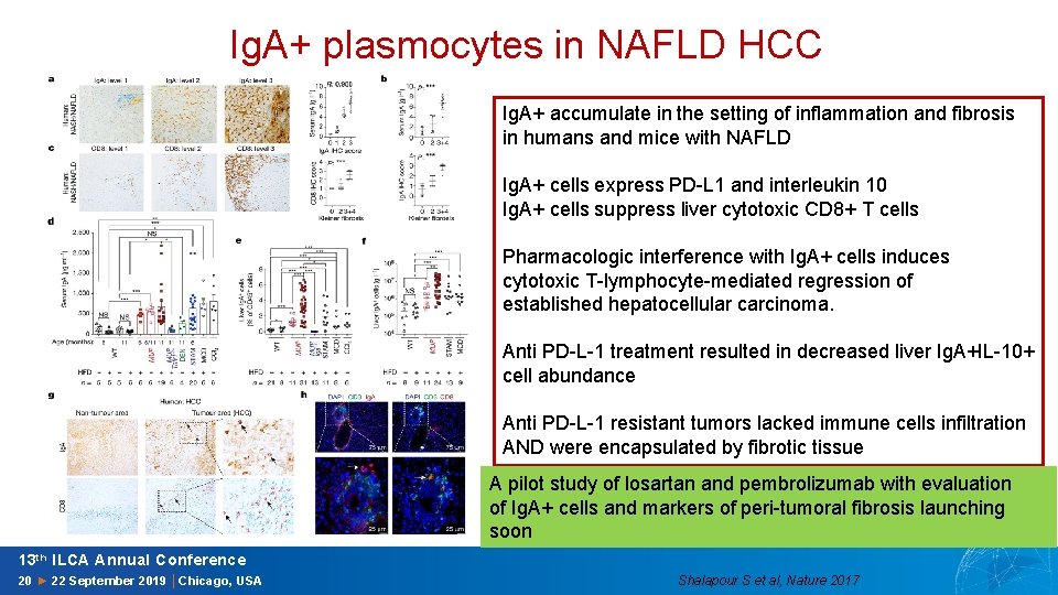 Ig. A+ plasmocytes in NAFLD HCC Ig. A+ accumulate in the setting of inflammation