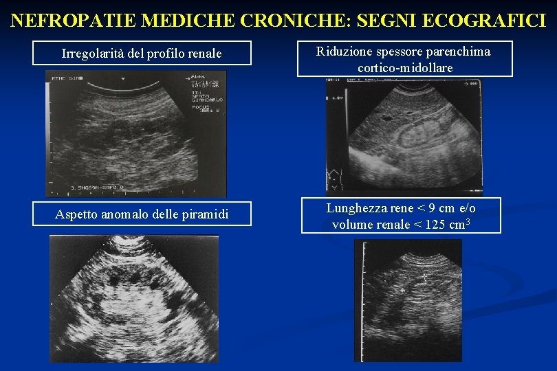 NEFROPATIE MEDICHE CRONICHE: SEGNI ECOGRAFICI Irregolarità del profilo renale Riduzione spessore parenchima cortico-midollare Aspetto