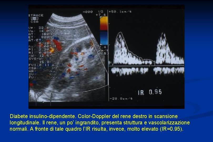 Diabete insulino-dipendente. Color-Doppler del rene destro in scansione longitudinale. Il rene, un po’ ingrandito,