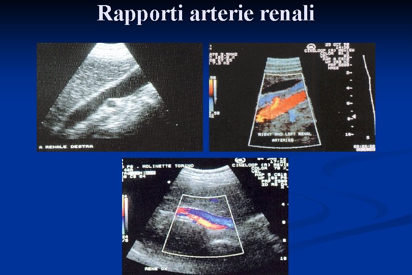 Rapporti arterie renali 