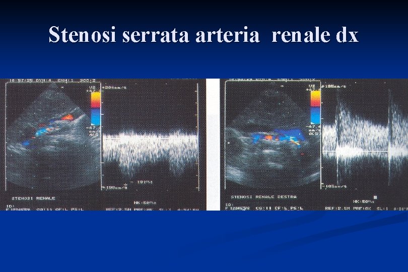 Stenosi serrata arteria renale dx 