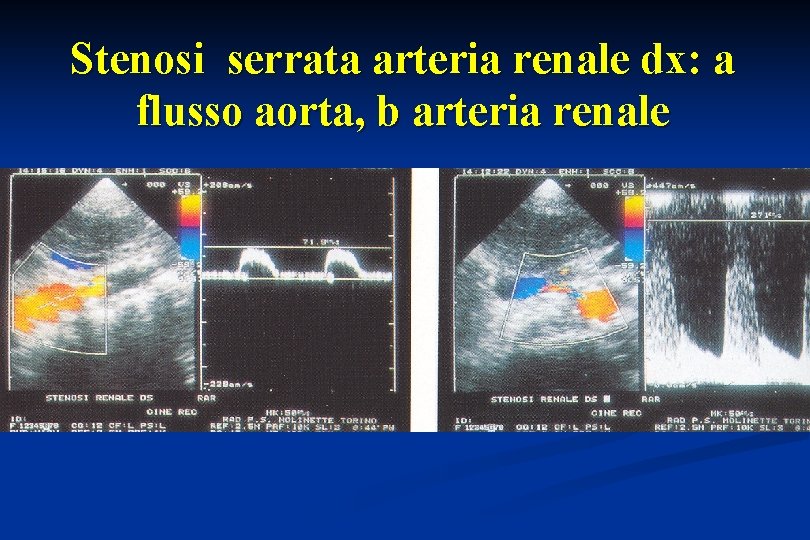 Stenosi serrata arteria renale dx: a flusso aorta, b arteria renale 