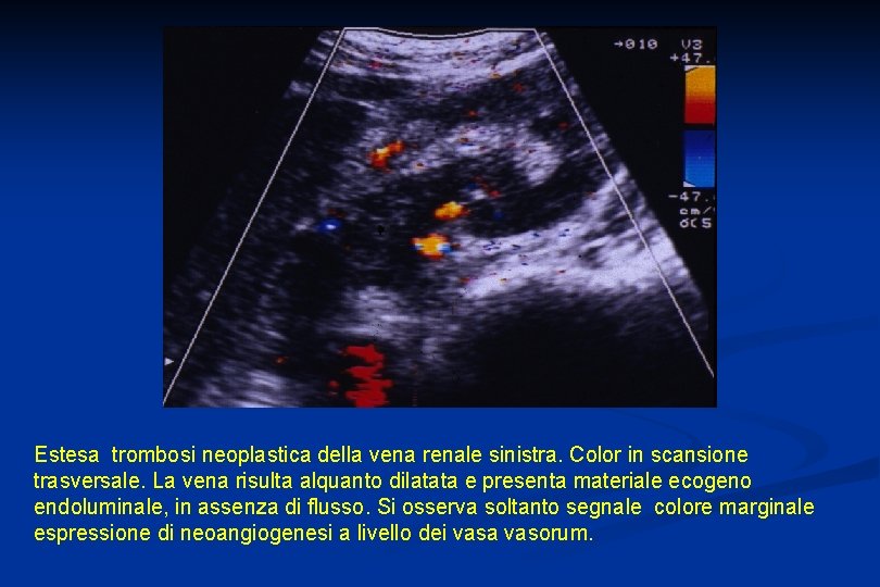 Estesa trombosi neoplastica della vena renale sinistra. Color in scansione trasversale. La vena risulta
