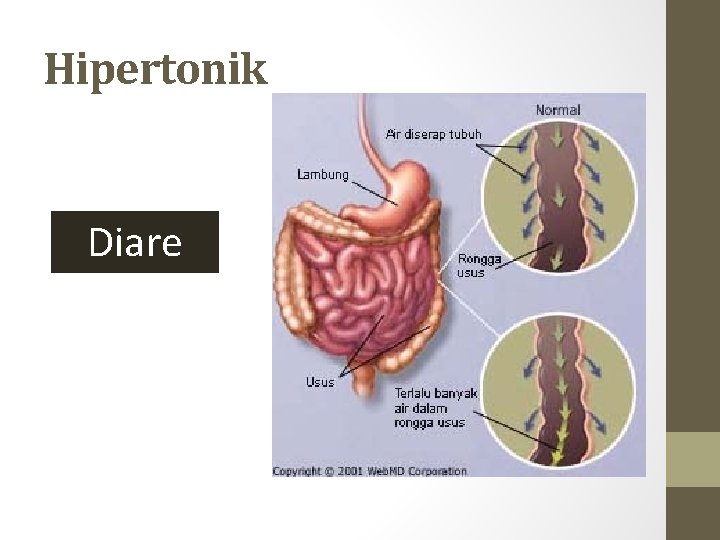 Hipertonik Diare Hipertonik Diare