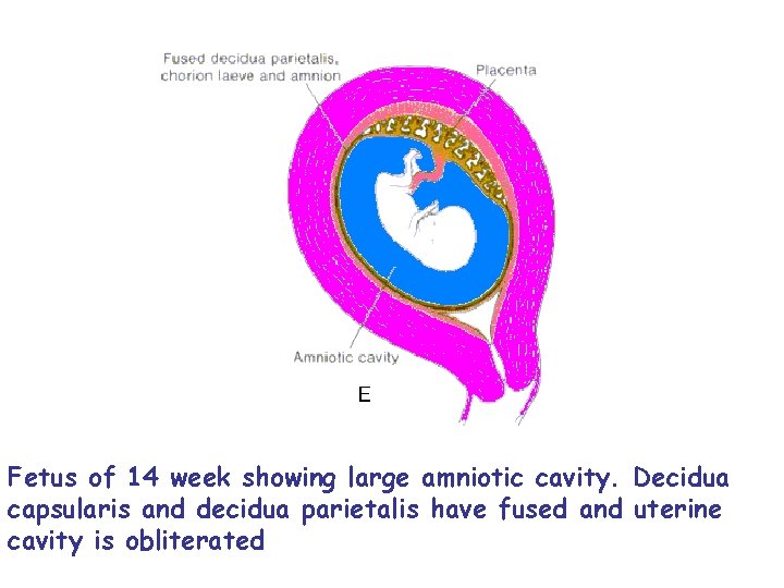 Fetus of 14 week showing large amniotic cavity. Decidua capsularis and decidua parietalis have