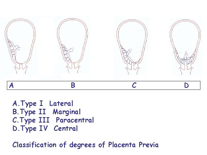 A B C A. Type I Lateral B. Type II Marginal C. Type III