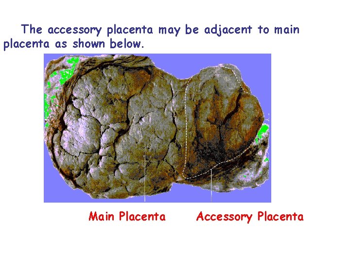 The accessory placenta may be adjacent to main placenta as shown below. Main Placenta