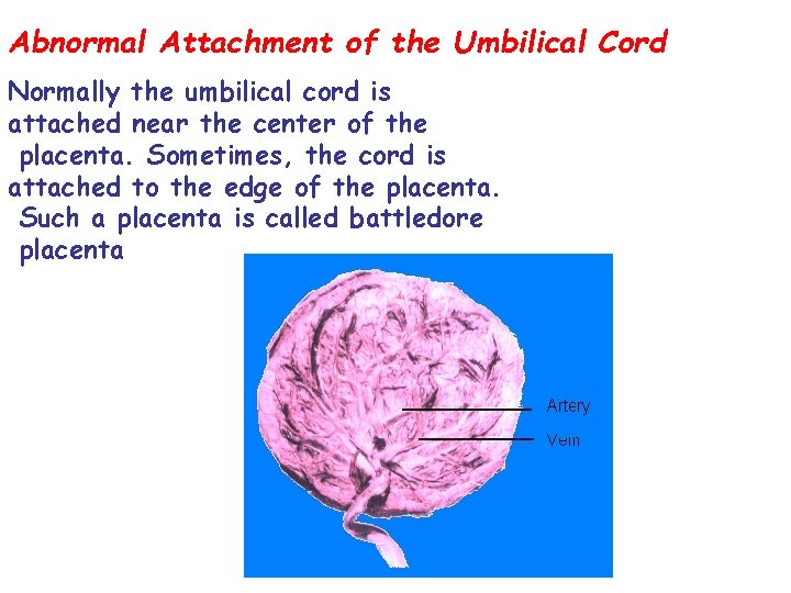 Abnormal Attachment of the Umbilical Cord Normally the umbilical cord is attached near the