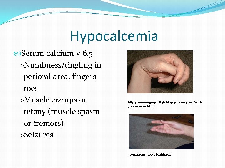 Hypocalcemia Serum calcium < 6. 5 >Numbness/tingling in perioral area, fingers, toes >Muscle cramps