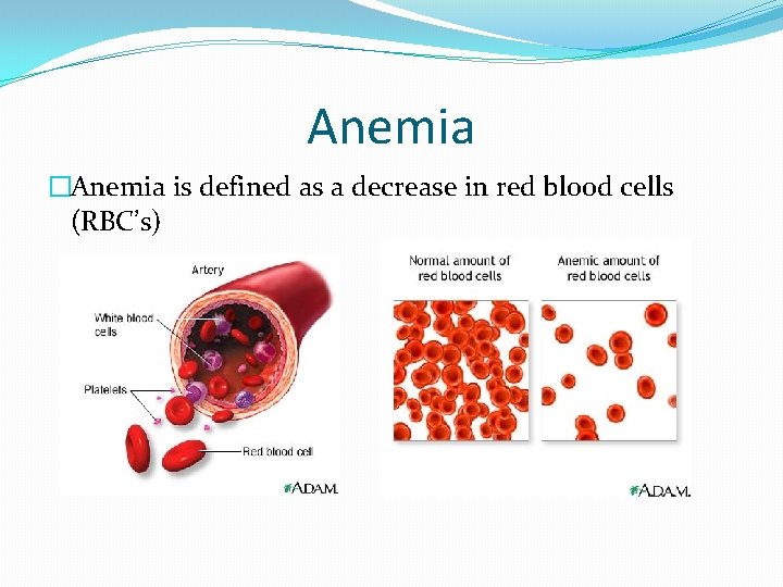 Anemia �Anemia is defined as a decrease in red blood cells (RBC’s) 