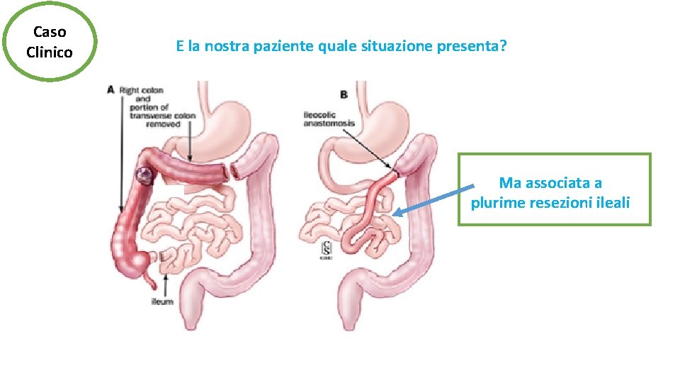 Caso Clinico E la nostra paziente quale situazione presenta? Ma associata a plurime resezioni