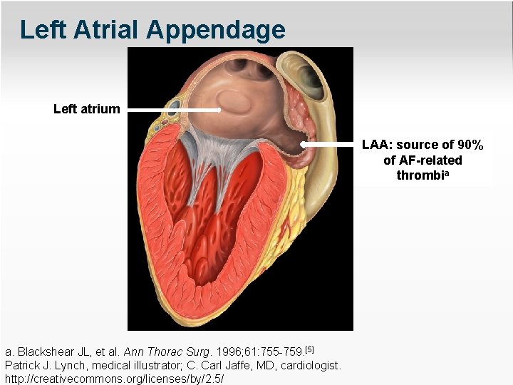 Left Atrial Appendage Left atrium LAA: source of 90% of AF-related thrombia a. Blackshear