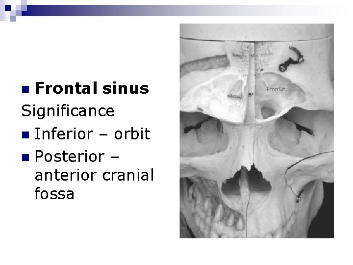 Frontal sinus Significance n Inferior – orbit n Posterior – anterior cranial fossa n