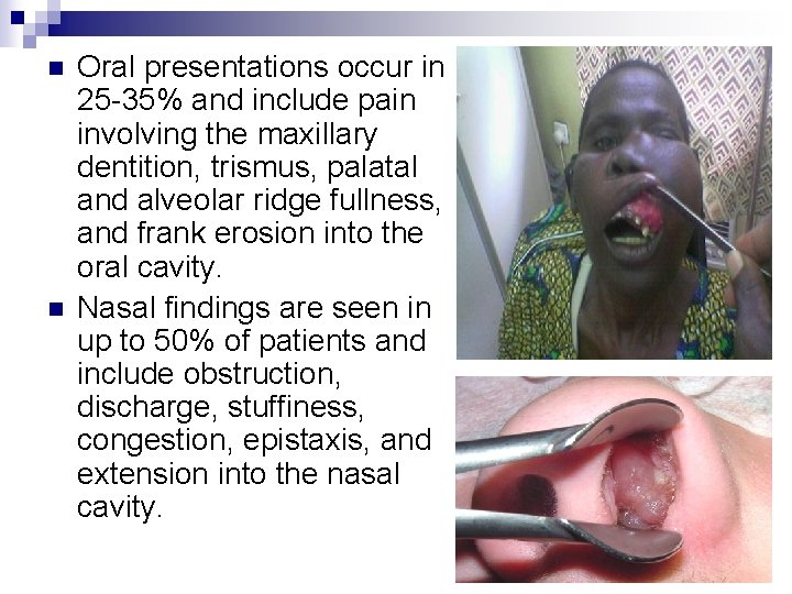 n n Oral presentations occur in 25 -35% and include pain involving the maxillary