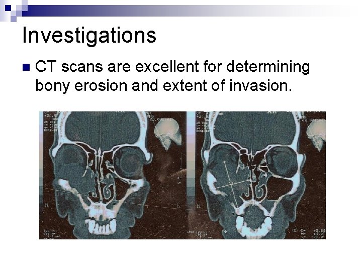 Investigations n CT scans are excellent for determining bony erosion and extent of invasion.