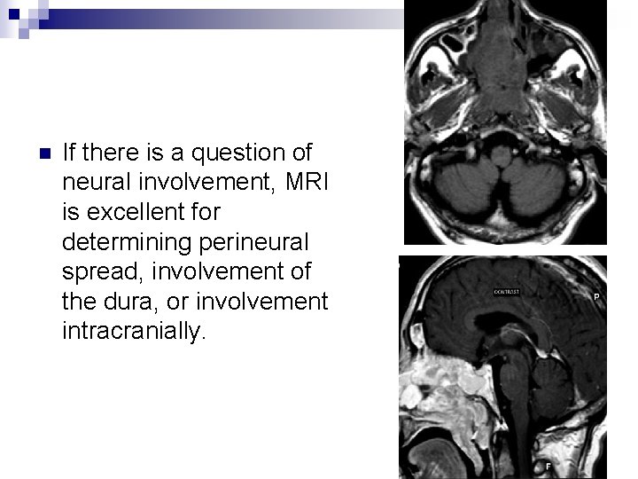 n If there is a question of neural involvement, MRI is excellent for determining