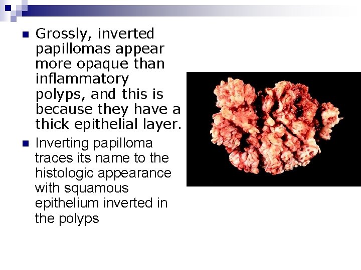 n n Grossly, inverted papillomas appear more opaque than inflammatory polyps, and this is