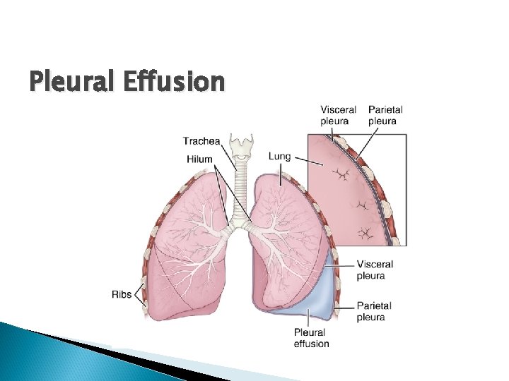 Pleural Effusion Pleural Effusion