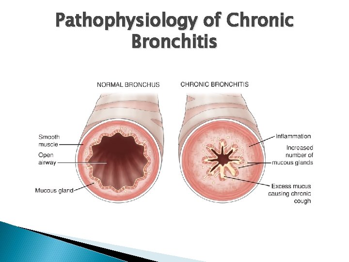 Pathophysiology of Chronic Bronchitis 