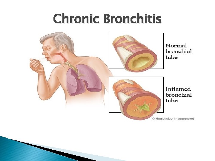 Chronic Bronchitis 