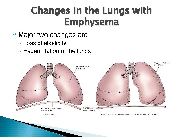 Changes in the Lungs with Emphysema Major two changes are ◦ Loss of elasticity