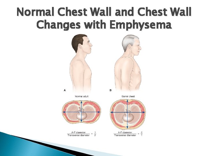 Normal Chest Wall and Chest Wall Changes with Emphysema 