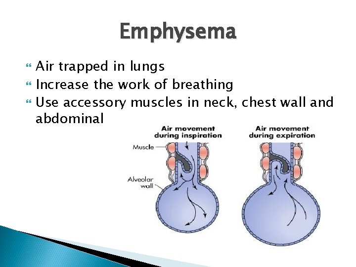 Emphysema Air trapped in lungs Increase the work of breathing Use accessory muscles in