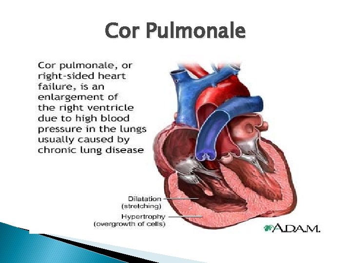 Cor Pulmonale 