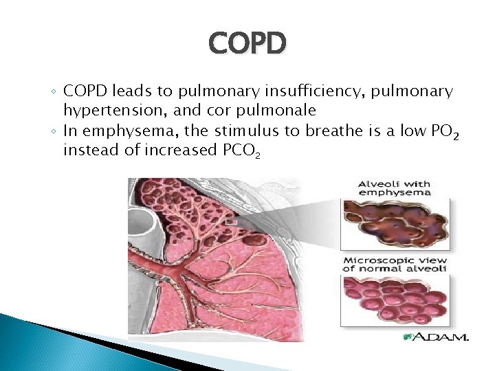 COPD ◦ COPD leads to pulmonary insufficiency, pulmonary hypertension, and cor pulmonale ◦ In