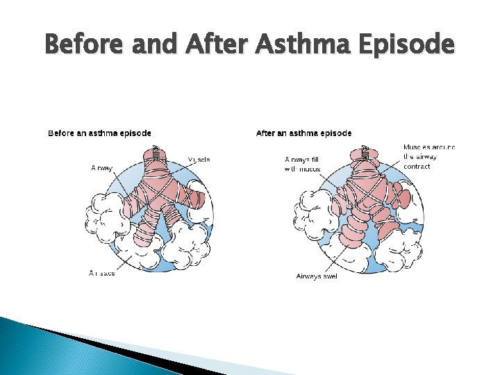 Before and After Asthma Episode 