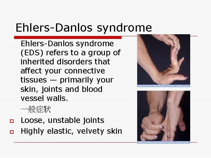 Ehlers-Danlos syndrome o o Ehlers-Danlos syndrome (EDS) refers to a group of inherited disorders