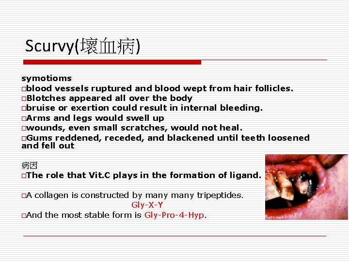 Scurvy(壞血病) symotioms oblood vessels ruptured and blood wept from hair follicles. o. Blotches appeared