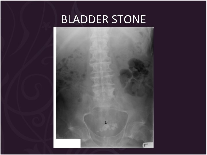 BLADDER STONE 